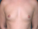 Patient # 45696 Before Photo # 1